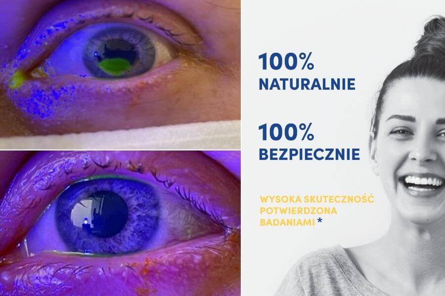 Zastosowanie kropli z&nbsp;osocza bogatopłytkowego OCULUS PRP SYSTEM poparzenie rogówki